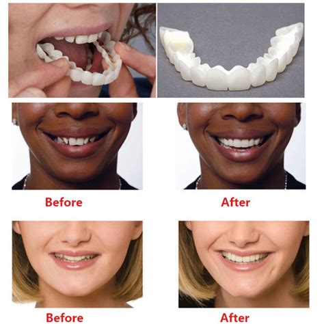 what kind of fake teeth are there